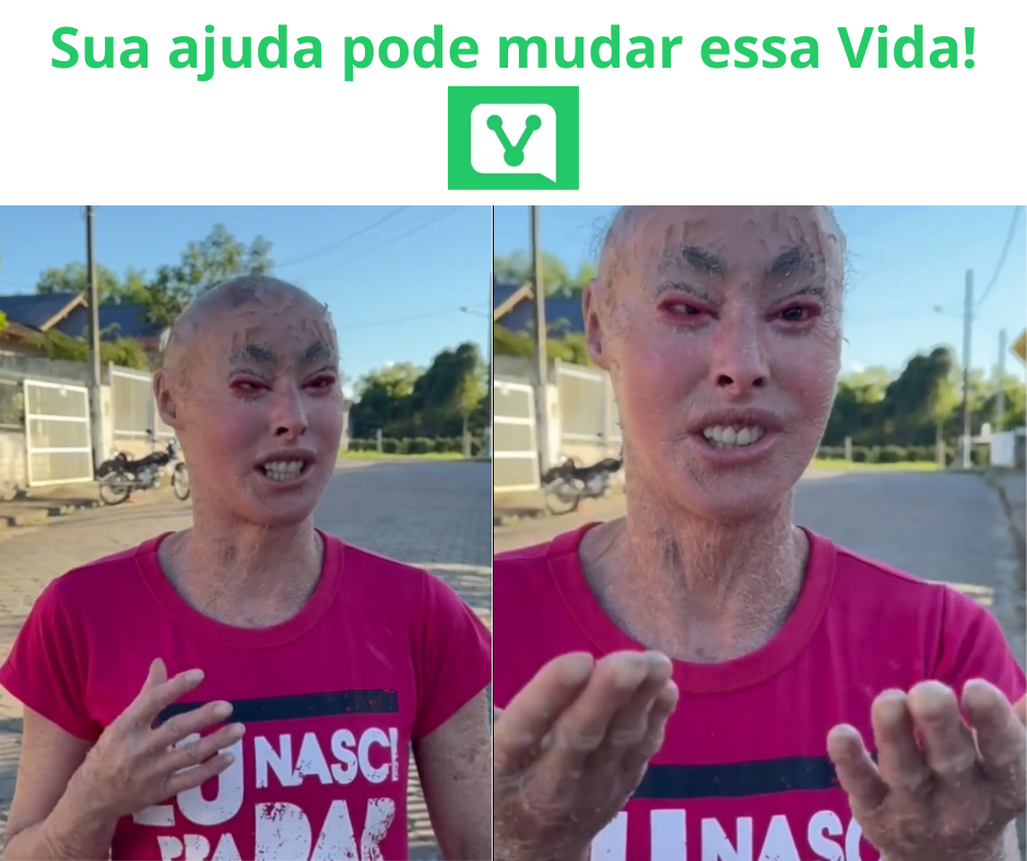 Daiane, 40 anos, enfrenta ictiose lamelar grave